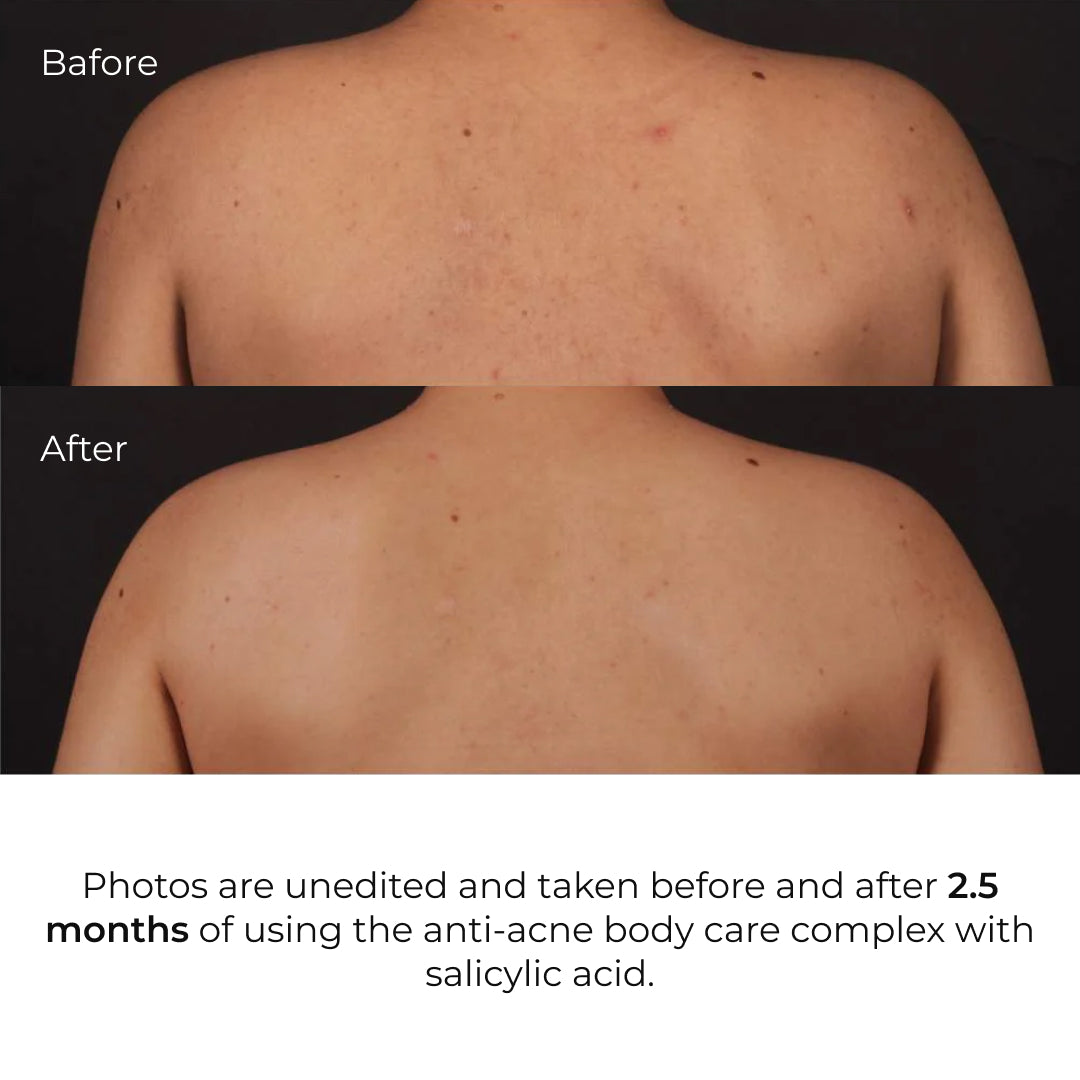 Kompleks przeciw wysypkom na ciele i głębokie odżywienie Hillary Body Acne & Deep Nourishment Complex