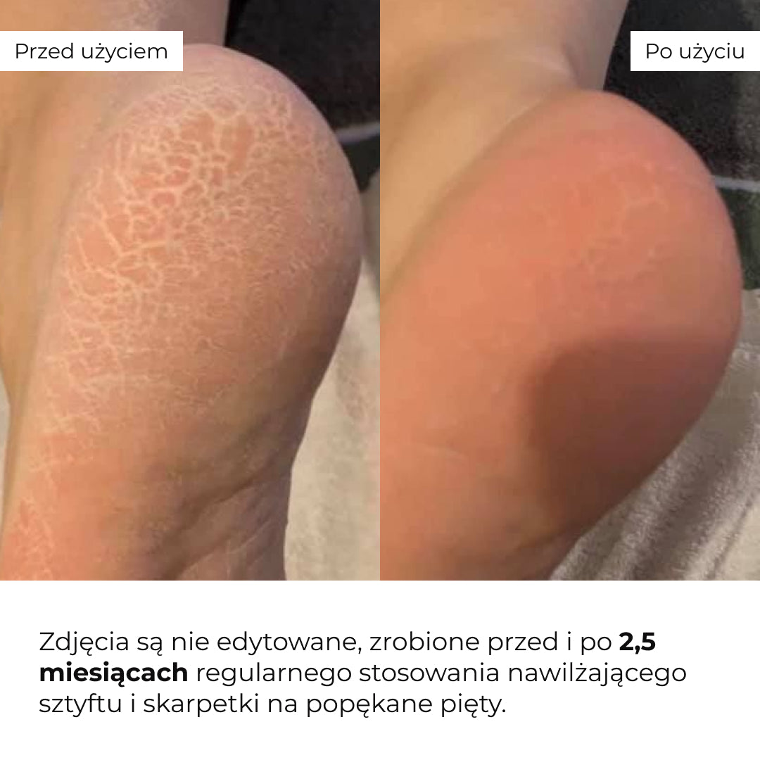 Zestaw przeciw pękającym piętom, suchości i nieprzyjemnemu zapachowi Hillary HydraHeel Repair & Odor Control