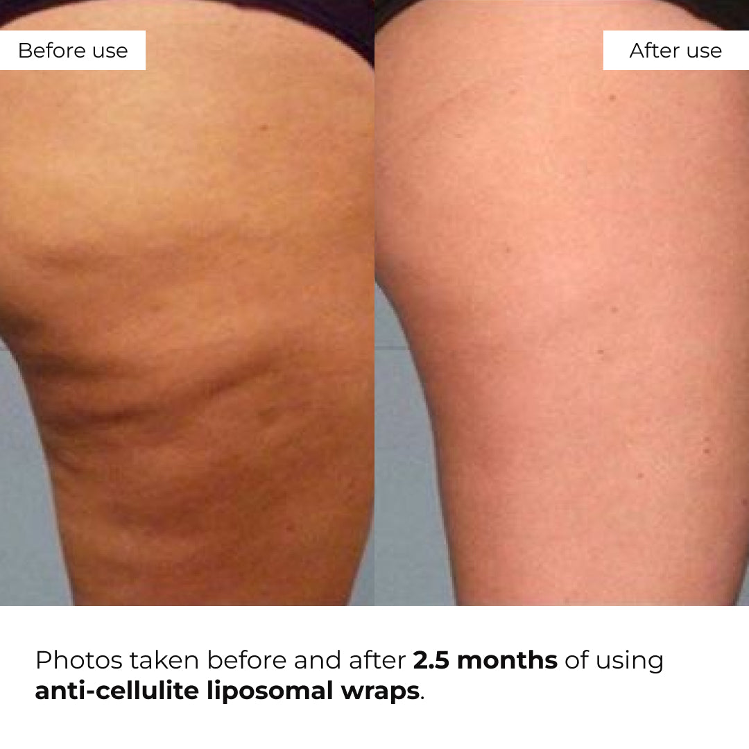 Zestaw chłodzących bandaży antycellulitowych Hillary Cooling Anti-Cellulite Wrap Set