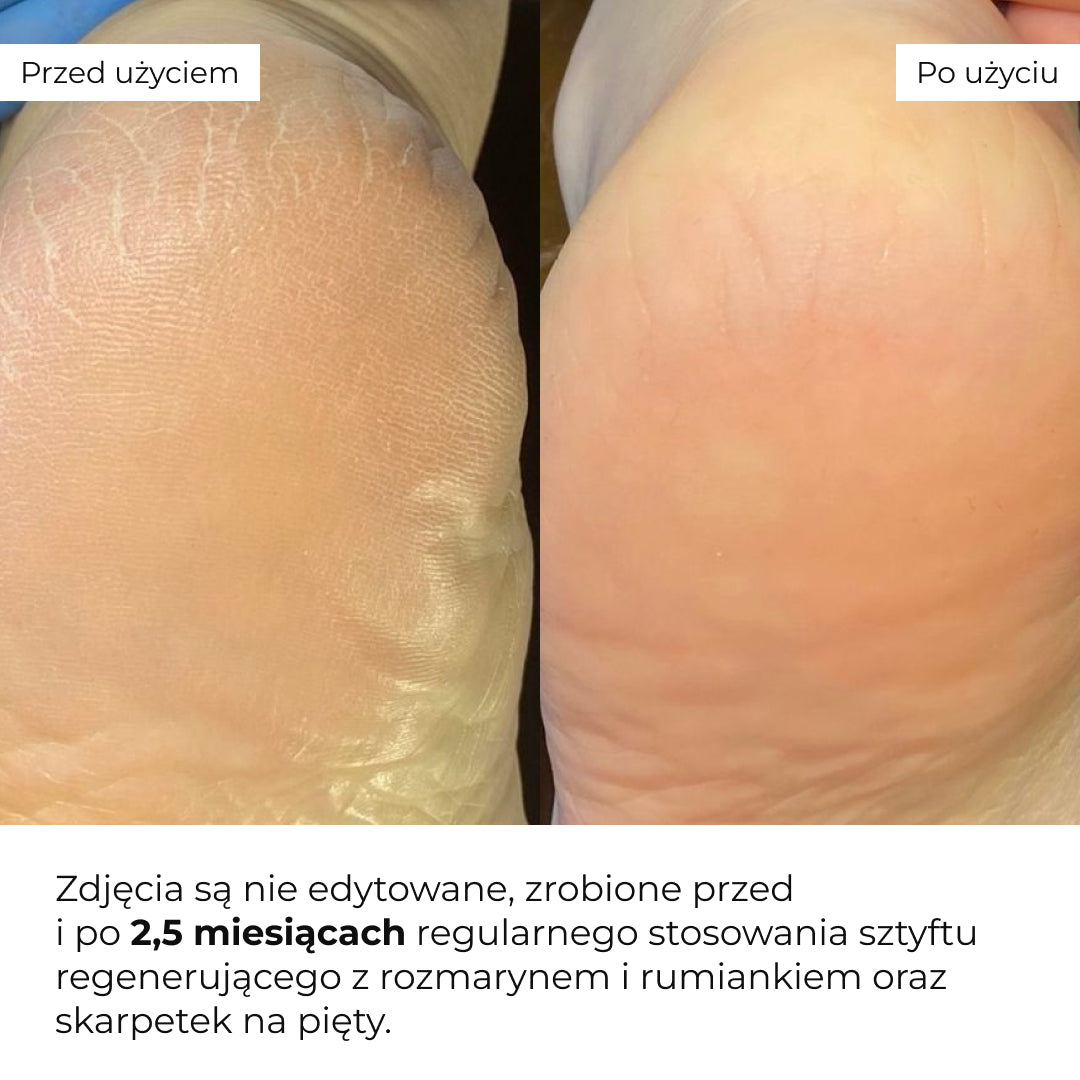 Zestaw na popękane pięty z rozmarynem i rumiankiem Hillary HydraHeel Repair & Comfort Set