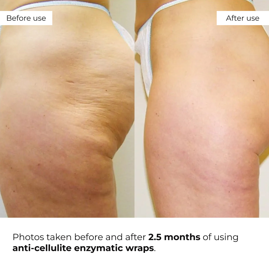 Zestaw rozgrzewających bandaży antycellulitowych Hillary Heating Anti-Cellulite Wrap Set