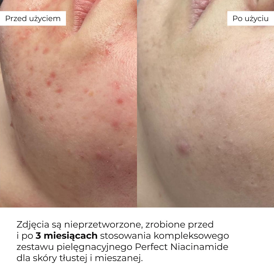 Zestaw do pielęgnacji skóry tłustej i mieszanej Hillary Perfect Niacinamide Sebo Balance
